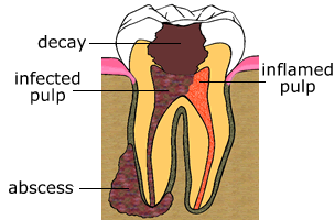 Decayed Tooth