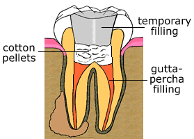 Temporary Filling